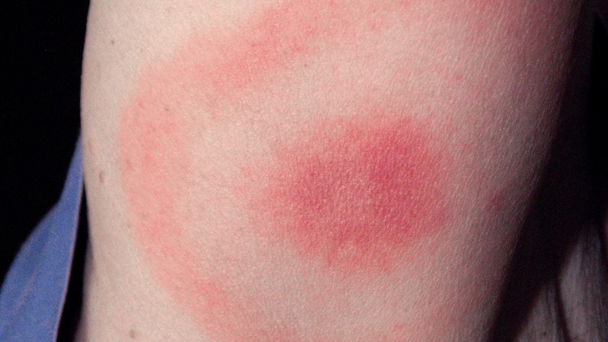 Circular red rash with central clearing that slowly expands is a sign of Lyme disease.