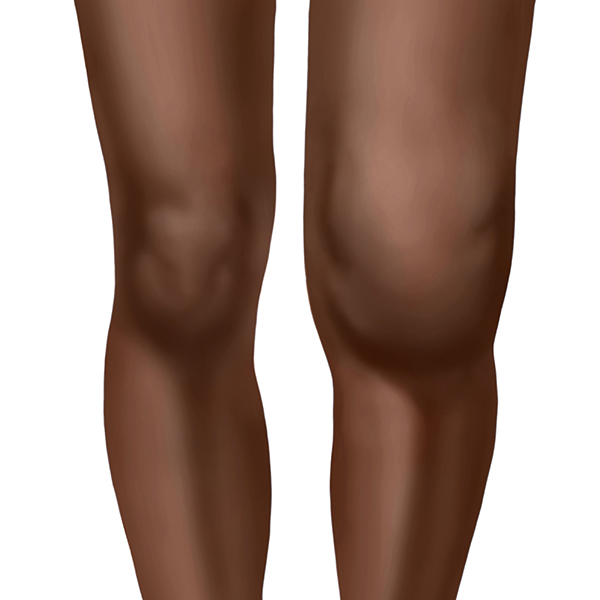 Image showing swollen arthritic knee
