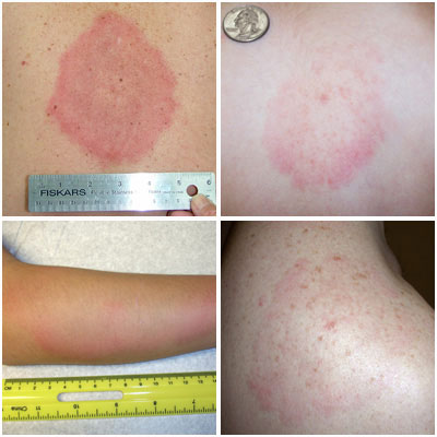 Southern tick-associated tick rash illness has many forms.