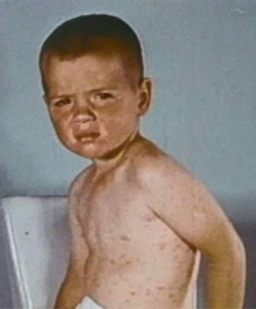 Ni&ntilde;o peque&ntilde;o que lleva 5 a 6 d&iacute;as con la enfermedad, con sarpullido y tos.