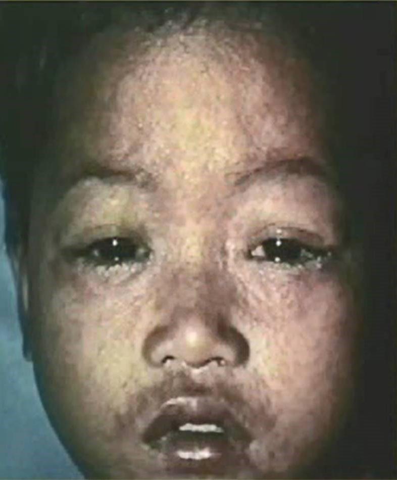 Ni&ntilde;o peque&ntilde;o, de piel oscura, con ojos llorosos, moqueo y sarpullido elevado.