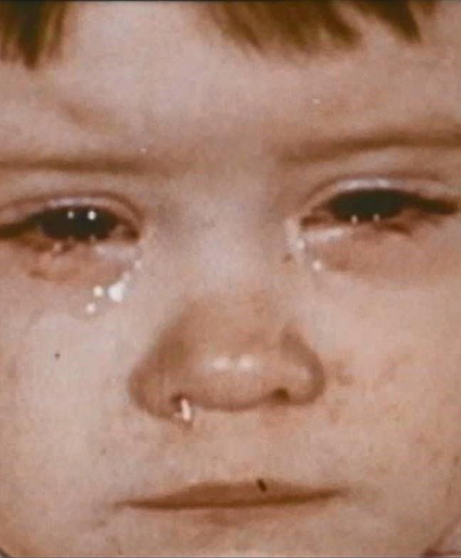 Ni&ntilde;o peque&ntilde;o con enfermedad moderada: moqueo y ojos llorosos causados por la infecci&oacute;n por el virus del sarampi&oacute;n.
