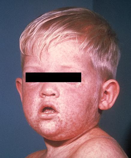 Cara de un ni&ntilde;o con sarampi&oacute;n (sarpullido de tres d&iacute;as).
