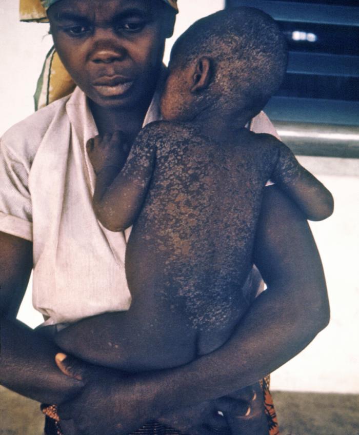 Esta fotograf&iacute;a de fines de la d&eacute;cada de 1960 muestra a una madre nigeriana y a su hijo que se est&aacute; recuperando del sarampi&oacute;n; notar que la piel del ni&ntilde;o se est&aacute; descamando a medida que se cura de su infecci&oacute;n por el virus del sarampi&oacute;n.