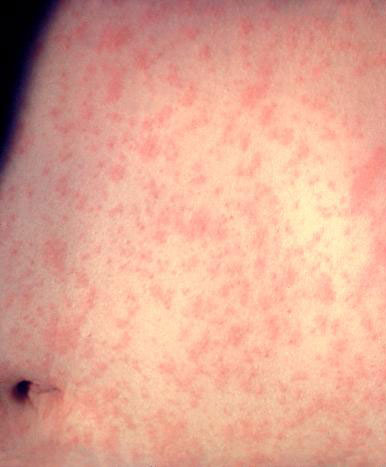 Esta es la piel de un paciente despu&eacute;s de 3 d&iacute;as con la infecci&oacute;n por el virus del sarampi&oacute;n.