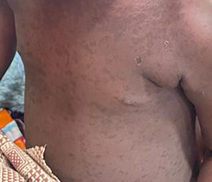 Imagen de sarpullido del sarampi&oacute;n en el torso de un ni&ntilde;o con piel m&aacute;s oscura.
