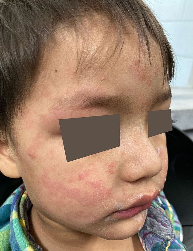 Imagen del sarpullido del sarampi&oacute;n en la cara y las mejillas de un ni&ntilde;o.