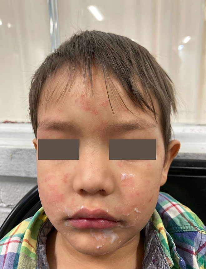Imagen del sarpullido del sarampi&oacute;n en la cara y las mejillas de un ni&ntilde;o.