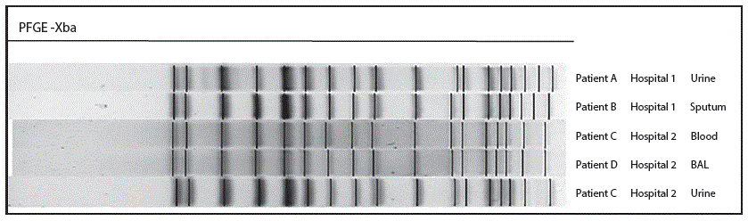 m6534a5f2.gif The figure above is a pulsed-field gel electrophoresis subtyping comparison of five KPC-producing Klesbsiella pneumoniae isolates digested with XbaI in Wisconsin during February–May 2015.