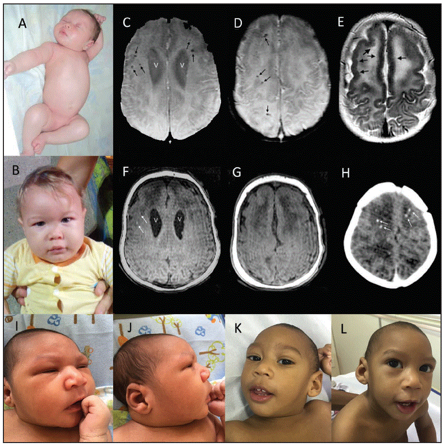 The figure above is a composite of clinical photographs, magnetic resonance, and computed tomography images of two infants with congenital Zika syndrome in Brazil during October 2015&ndash;Octoboer 2016.