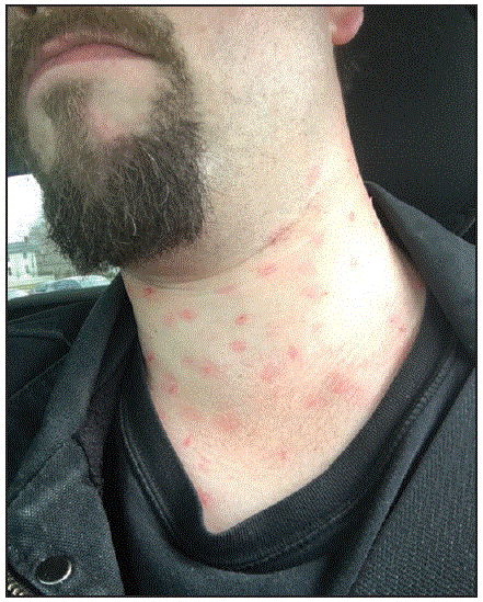 The figure above is a photograph showing a patient actor displaying a moulage-simulated measles rash in mystery patient drills in New York City during December 2015&ndash;May 2016.
