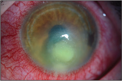 The figure above is a photo that shows findings characteristic of a contact lens&ndash;related corneal infection.
