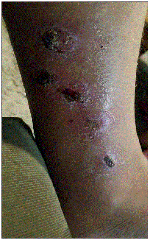 The figure is a photograph showing a Corynebacterium diphtheriae&ndash;infected lower leg wound in a patient from New Mexico in 2018.