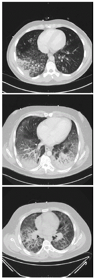 The figure consists of three computerized tomography images showing diffuse lung infiltrates in three patients with e-cigarette&ndash;associated severe lung disease in North Carolina, during July&ndash;August 2019.