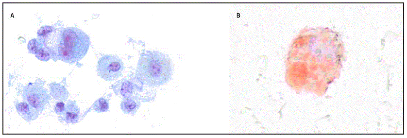 The figure shows microscopy of a bronchoalveolar lavage sample (Papanicolaou stain and oil red O stain) from a patient with acute lung injury associated with vaping in North Carolina, during July&ndash;August 2019.