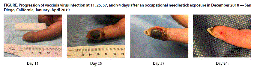 The figure consists of a panel of photos showing the progression of vaccinia virus infection in a finger at 11, 25, 57, and 94 days after an occupational needlestick exposure in December 2018, in San Diego, California, during January&ndash;April 2019.