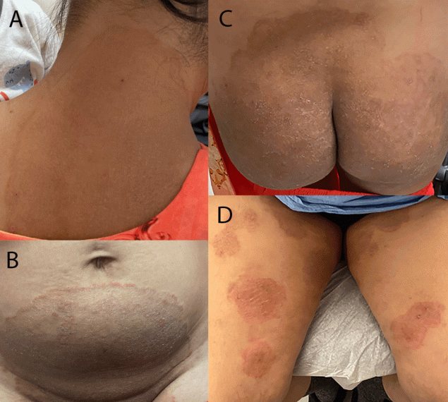 The figure includes four photographs of lesions occurring on the neck, abdomen, and thigh areas of two patients in New York City, caused by the first reported U.S. cases of tinea due to Trichophyton indotineae infection during December 2021&ndash;March 2023.