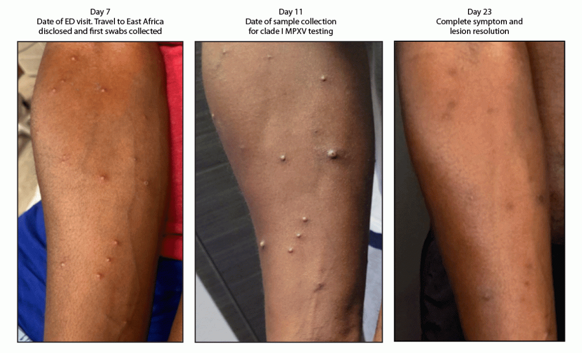 The figure is a series of three photographs illustrating progression of lesions in a patient with clade 1b monkeypox virus infection 7, 12, and 23 days after return to the United States from East Africa in California during 2024.