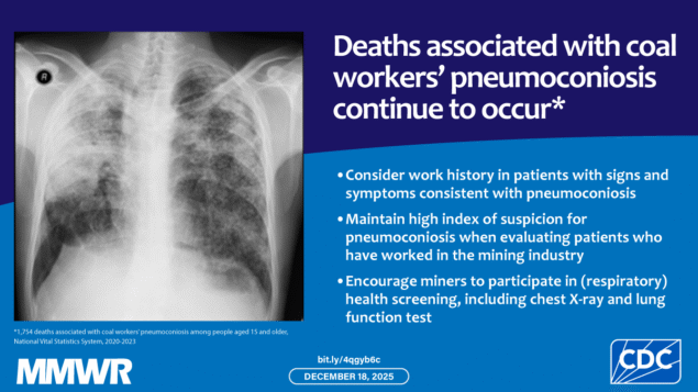 Coal Workers’ Pneumoconiosis–Associated Deaths — United States, 2020–2023… The image shows the chest X-ray from a coal worker with pneumoconiosis with text that reads, “Deaths associated with coal workers’ pneumoconiosis continue to occur. Consider work history in patients with signs and symptoms consistent with pneumoconiosis, maintain high index of suspicion for pneumoconiosis when evaluating patients who have worked in the mining industry, and encourage miners to participate in (respiratory) health screening, including chest X-ray and lung function test.”