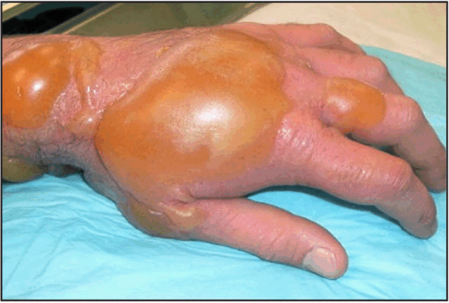 Notes from the Field: Exposures to Chemical Munitions During Commercial Fishing Operations — New Jersey, 2016–2023 The figure a photo illustrating an example of an injury to skin exposed to sulfur mustard–containing chemical warfare munitions.