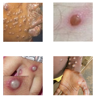 monkeypox photos from different parts of the body