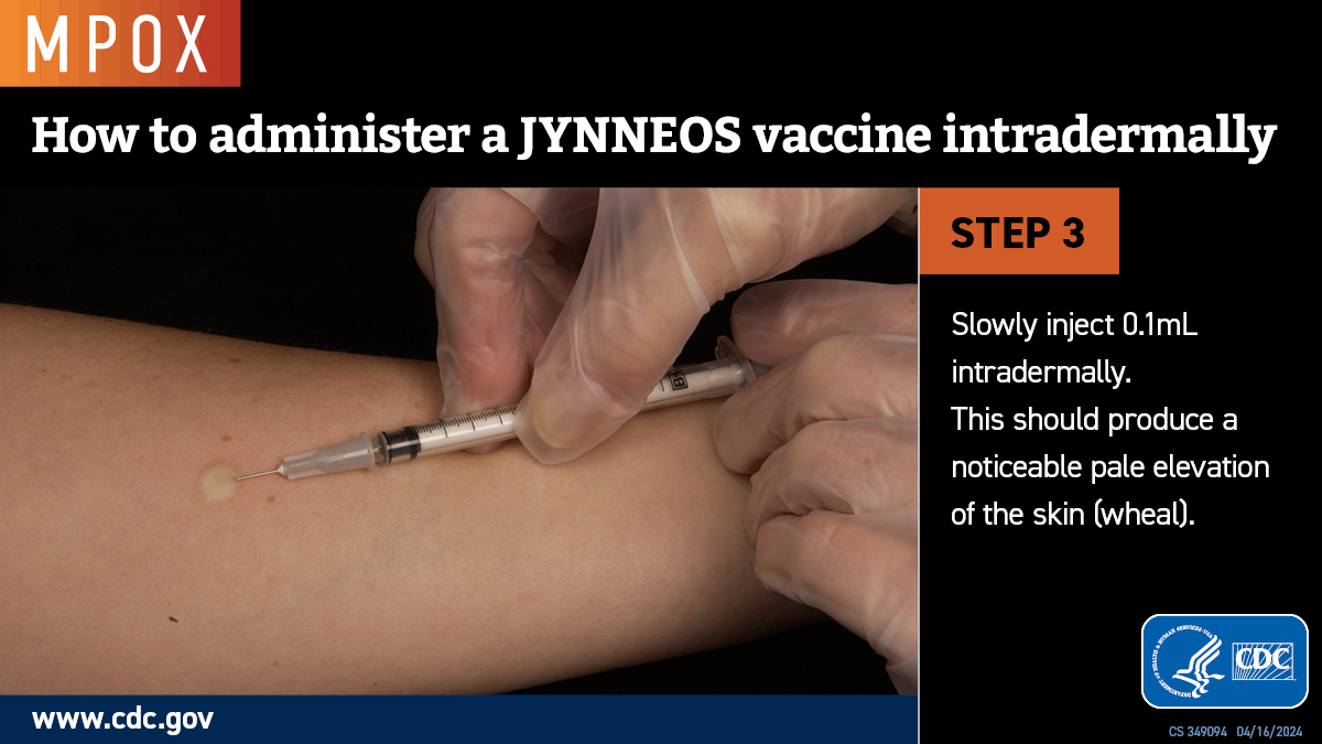 Photo showing a small, pale elevation of the skin where injection occurred.