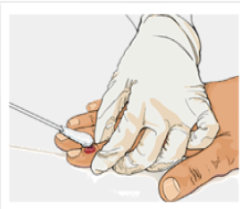 Illustration of a healthcare provider collecting a monkeypox specimen from a finger