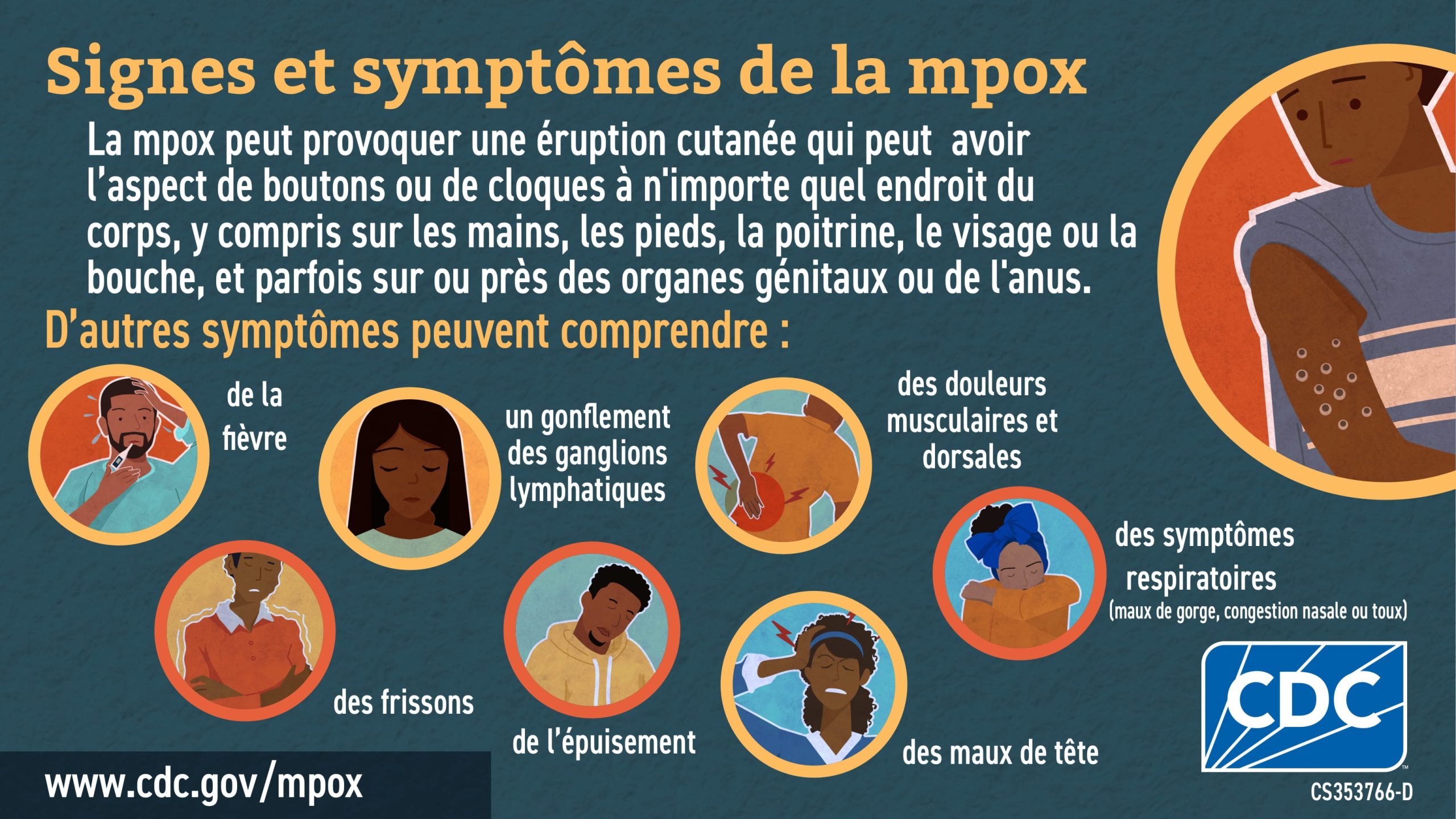 (In African French) Signes et symptômes de la monkeypox