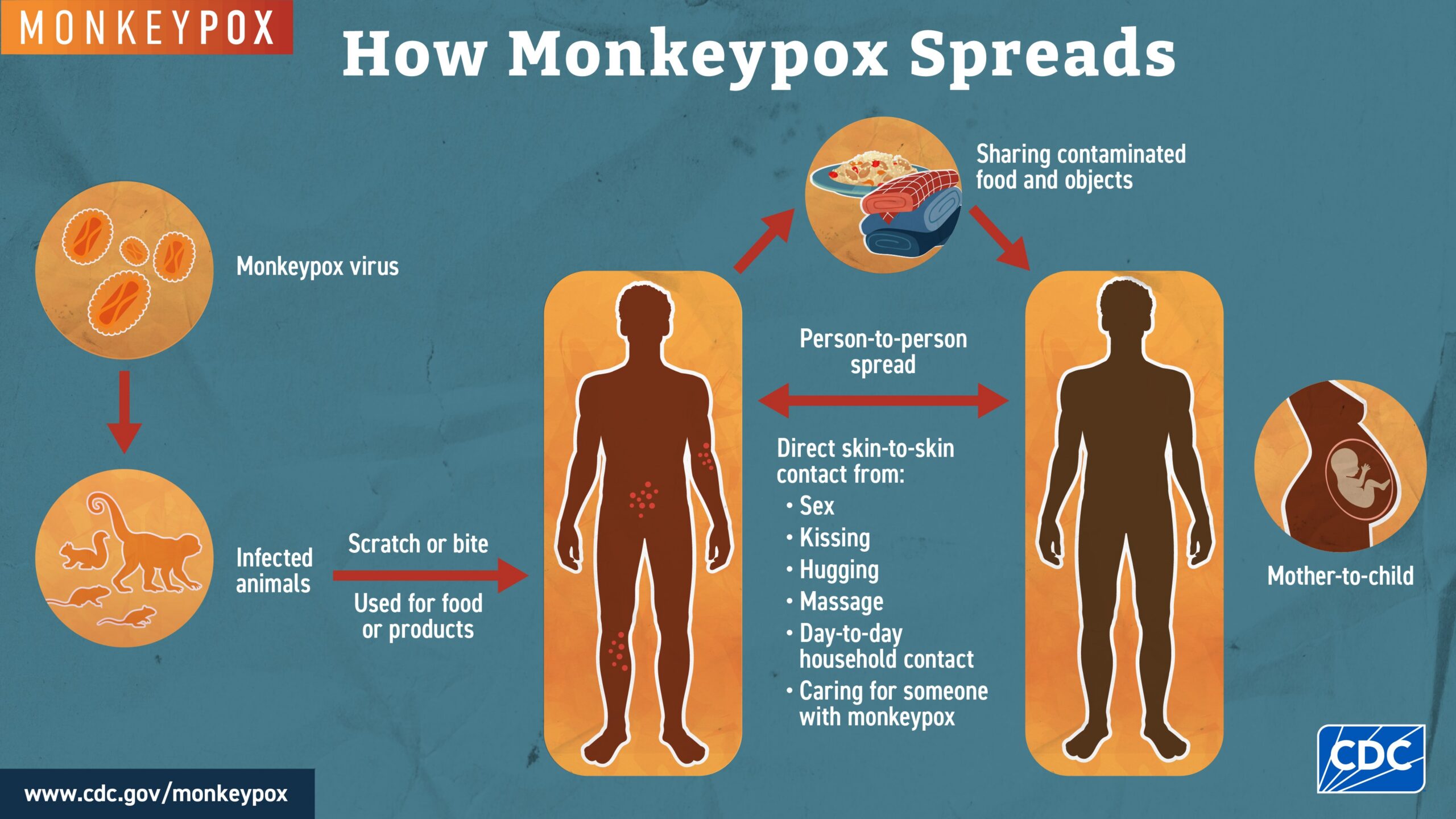 Monkeypox spreads from animals to people at first, then people spread it to other people by close, skin-to-skin contact.