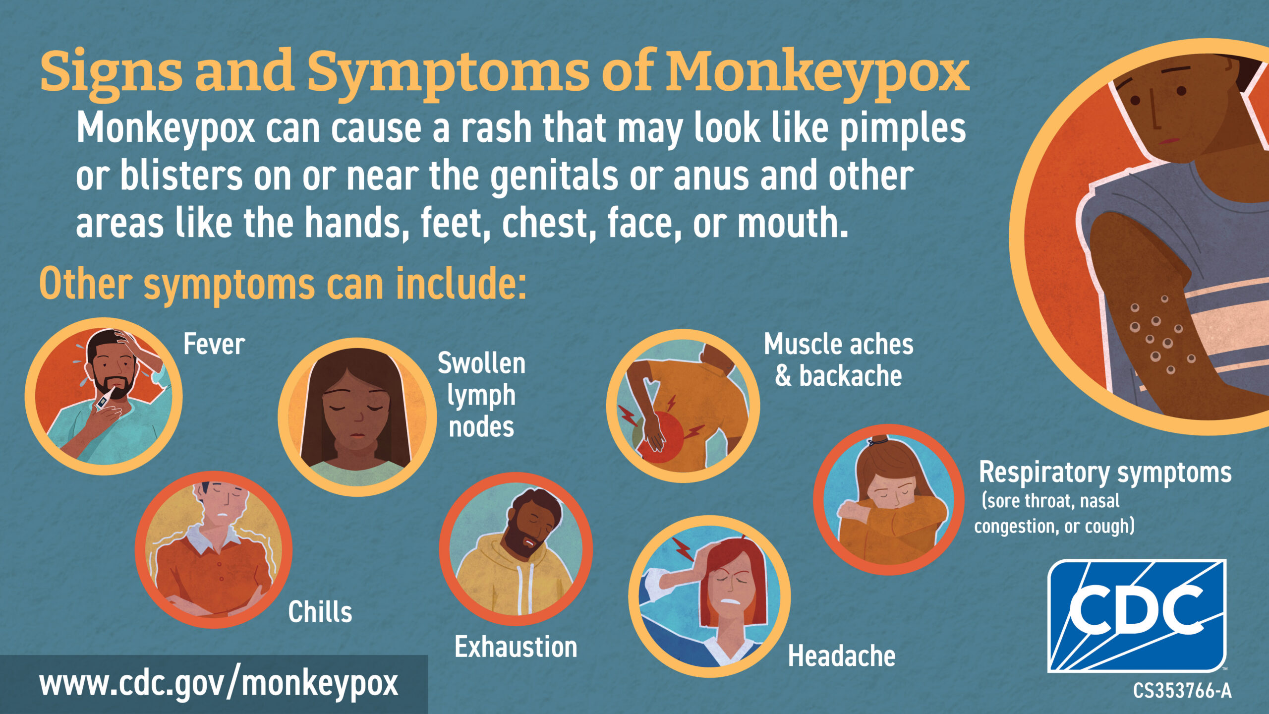 Symptoms include fever, chills, swelling of lymph nodes, fatigue, muscle and back pain, headache, and respiratory symptoms