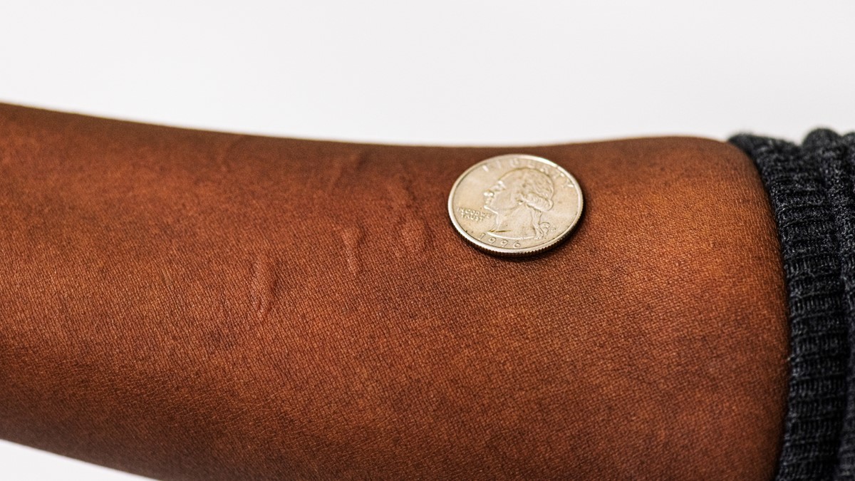 Mosquito bites on forearm Photo showing multiple mosquito bites on a person's forearm and a U.S. quarter to show scale