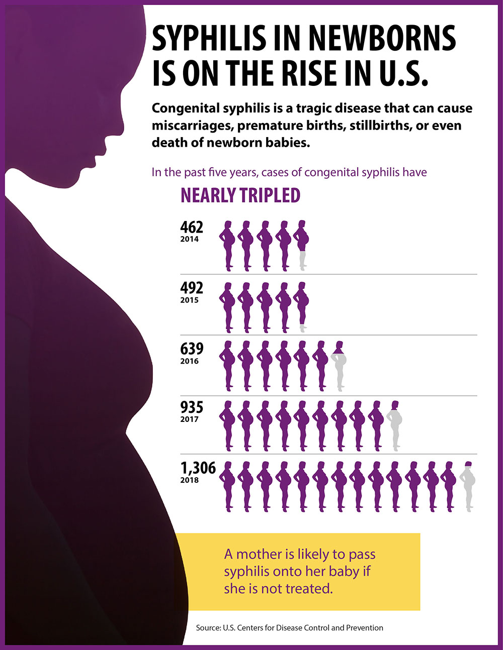 Syphilis in newborns is on the rise in the US