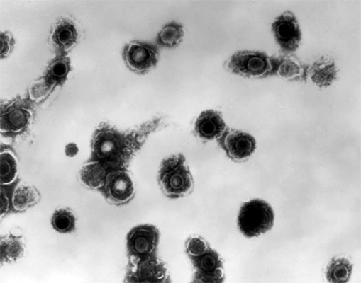 Chickenpox Chickenpox under microscope