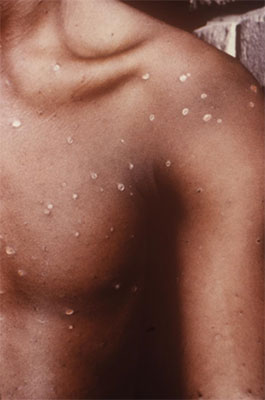 Chickenpox rash on chest Chickenpox rash on chest