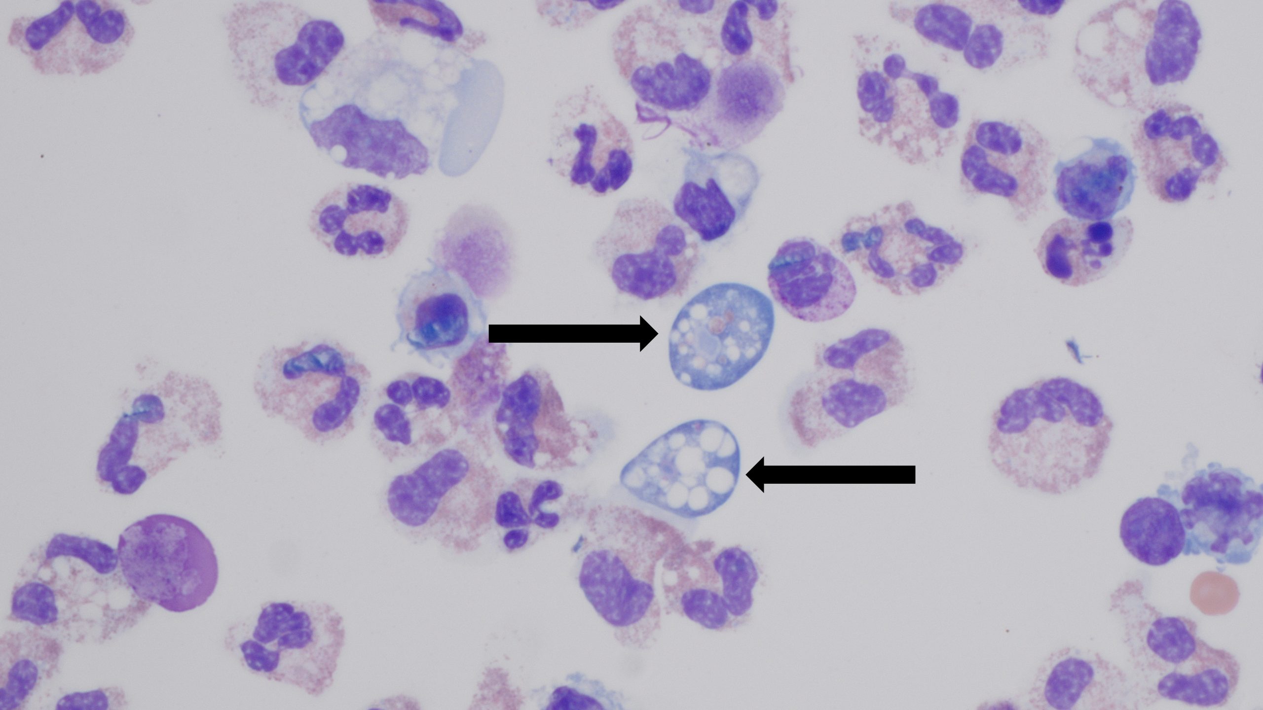 Dos flechas indican la presencia de Naegleria fowleri en el l&iacute;quido cerebral de una persona.