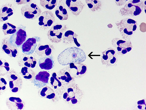 Naegleria fowleri in a patient’s cerebrospinal fluid. Arrow points to infectious form of the ameba.