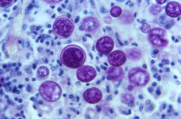 Under a magnification of 500X, this photomicrograph of a periodic acid&ndash;Schiff (PAS)-stained lymph node tissue sample, revealed the presence of a number of Coccidioides immitis (the fungus that causes Valley fever) spherules in various stages of development.