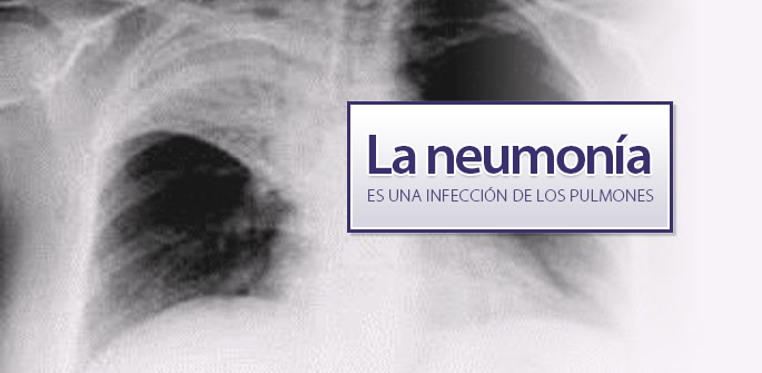 Radiograf&iacute;a de los pulmones con neumon&iacute;a