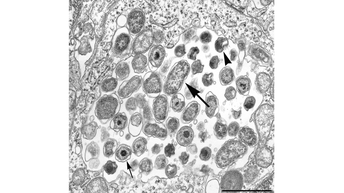Electron micrograph of Chlamydia psittaci inside human cells.