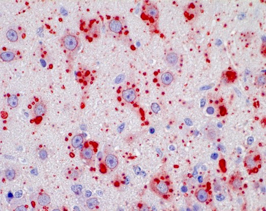 Positive IHC; rabies-infected neuronal cells of the brain