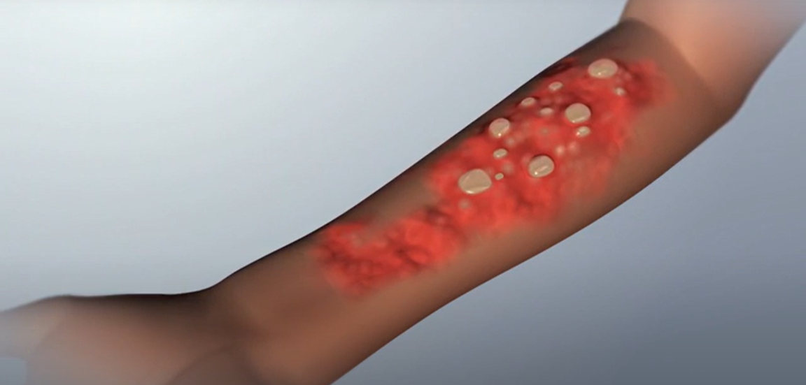 CRI injury Brazo con lesiones cutáneas por radiación