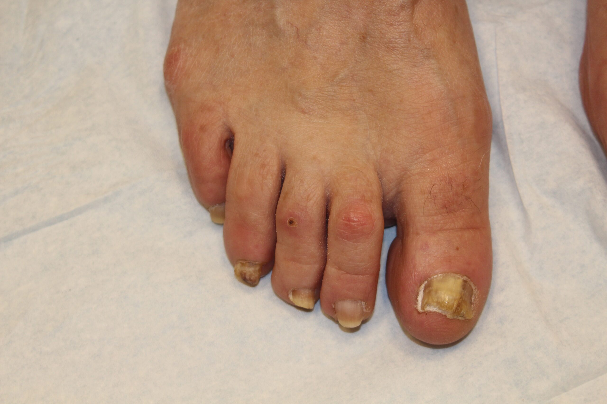 Close up of a foot showing a fungal nail infection