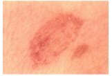 Medical photograph of ringworm on the back showing a red splotch on white skin.