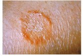 Medical photograph of ringworm of the arm showing a red circle rash.