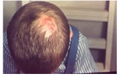 Medical photograph of ringworm of the scalp showing a bald spot on the head.