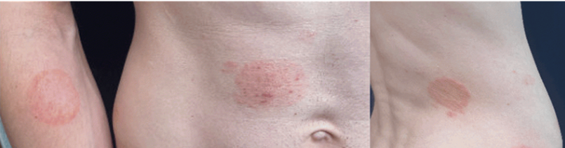 Image of ring-shaped lesions of TMVII located on the right arm and torso on white skin.