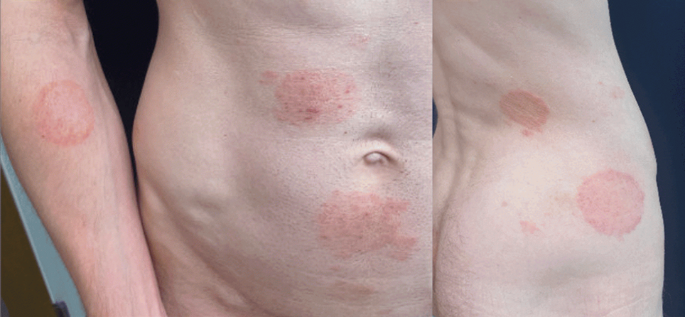 Image of ring-shaped lesions of TMVII located on the right arm and trunk, on white skin.