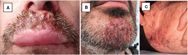 Three images of TMVII lesions showing lesions on the mustache in A, beard in B and groin in C, all on white skin.