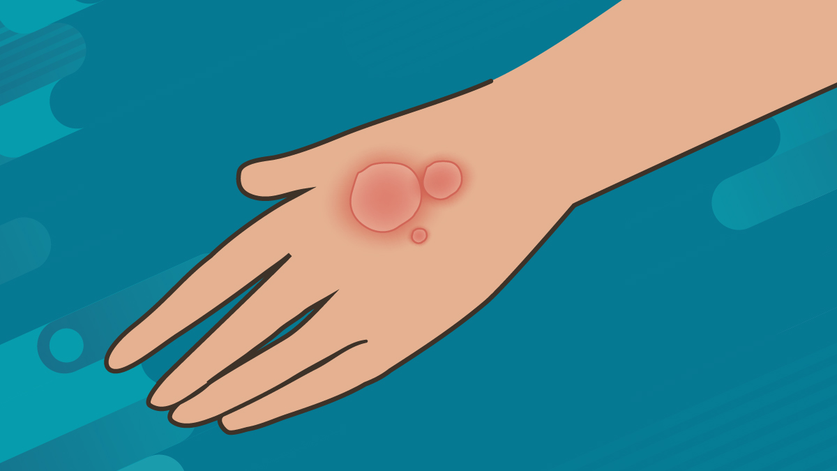 illustration of red ring-shaped rash on a hand