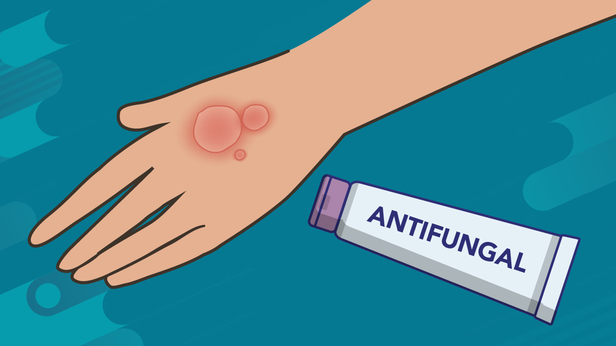 An illustration of a hand with ringworm and an antifungal ointment
